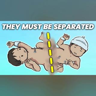 What Happens When Conjoined Twins Must Be Separated