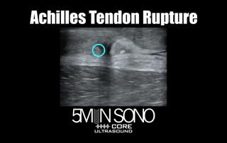 5 Minute Sono: Achilles Tendon Rupture