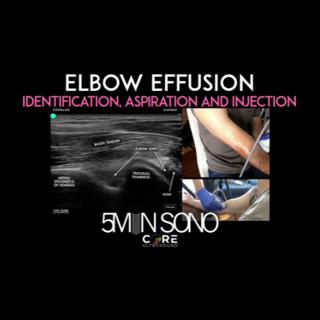 Elbow Effusion - Identification, Aspiration and Injection