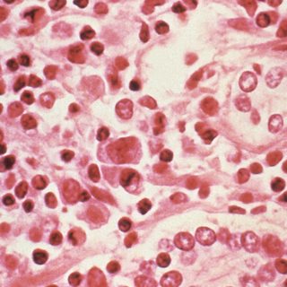 WHO: Hantavirus may have spread between humans