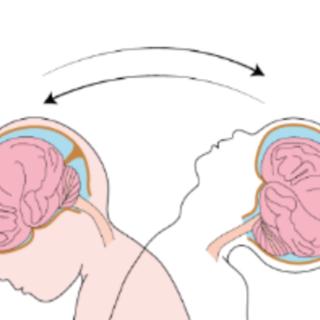 Kontroversen om "shaken baby syndrome"