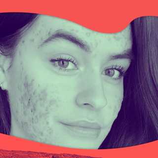 Isolerad av aknen – blev influencer