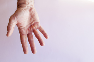 353. Dupuytren's Contracture