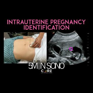 Intrauterine Pregnancy Identification with Point-of-Care Ultrasound (5MS)
