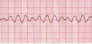 Podcast 678: ECMO for Refractory VFib