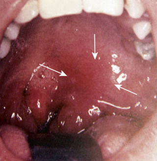 Podcast 761: Peritonsillar Abscess: To Stab or Not to Stab?