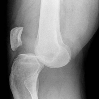 Knee Dislocation