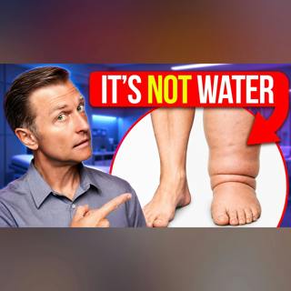 Lymphedema: What Doctors Don't Tell You (Diet Connection)