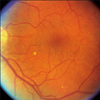 Association of Dietary and Supplementary Calcium Intake With Age-Related Macular Degeneration