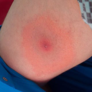 Review of Lyme Disease