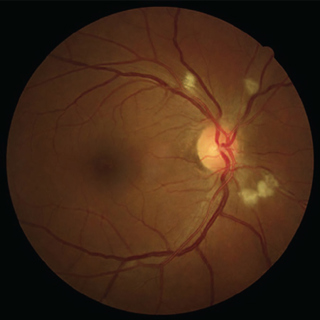 Retinopathy Characterization Among Patients With Yellow Fever in Southeastern Brazil