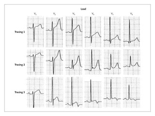 Podcast 696: ST Elevation and Differential Diagnoses