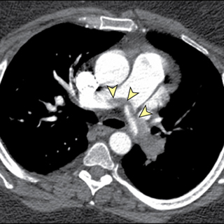 Updated Pulmonary Embolism Guidelines