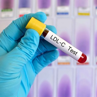 #96 Är högt LDL alltid farligt?