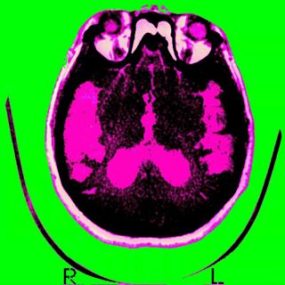 Good news about Alzheimer’s