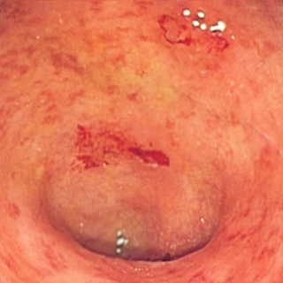 Update on Ulcerative Colitis—2020