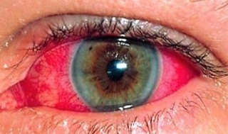Podcast # 330: Behcet Disease