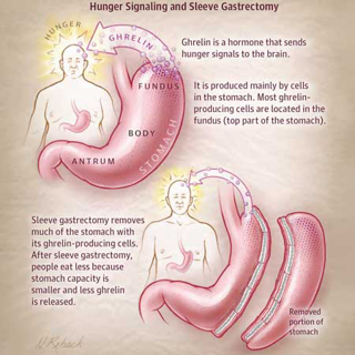 Gastric Sleeve Resection for Obesity: How good Is It?