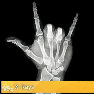Fun Facts About X-Rays