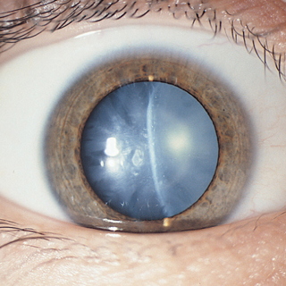Preoperative Disclosure of Resident Roles in Cataract Surgery in Teaching Centers