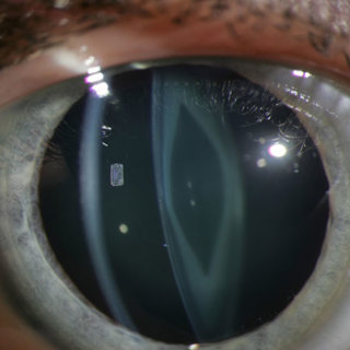 Visual Acuity and Ophthalmic Outcomes in the Year After Cataract Surgery Among Children