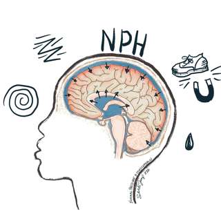 Normal Pressure Hydrocephalus: Only the Good Die Young