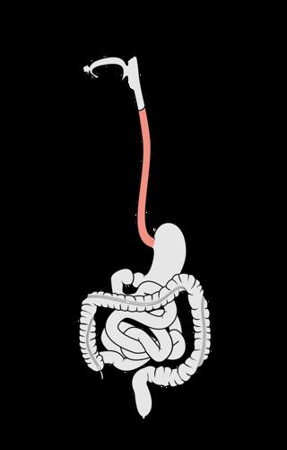 Podcast #231: Esophageal Tearing