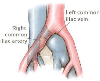 Podcast #196: DVT and May-Thurner Syndrome
