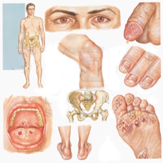 Reiter's Syndrome