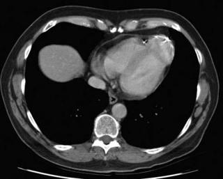 Podcast # 364: Other causes of ST elevation