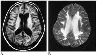 Podcast # 466: Subacute Sclerosing Panencephalitis