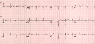 Podcast # 359: Normal EKG