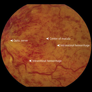 Monthly vs Treat-and-Extend Anti-VEGF Regimens After 6 Months of Treatment for Macular Edema From Retinal Vein Occlusion