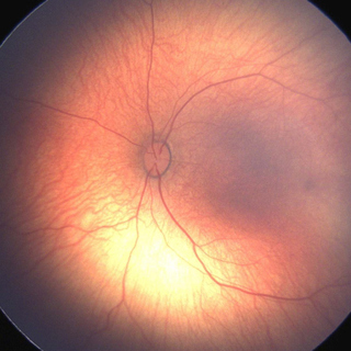 Factors in Premature Infants Associated With Low Risk of Developing Retinopathy of Prematurity