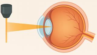 435. Laser Refractive Surgery