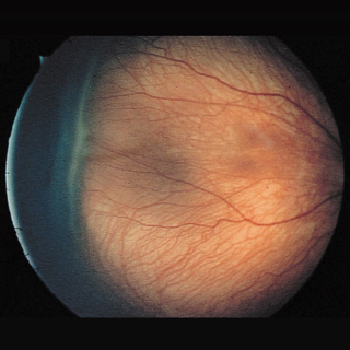 Cost-effectiveness of Artificial Intelligence–Based Retinopathy of Prematurity Screening
