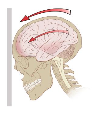 Podcast #281: Intracranial Hemorrhage Treatment