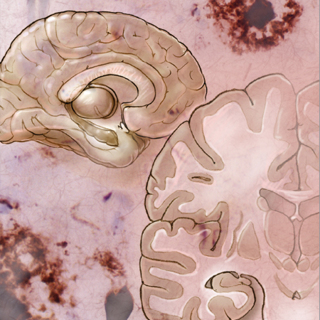 Parkinson Disease