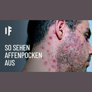 Was wäre, wenn man sich mit Affenpocken infiziert
