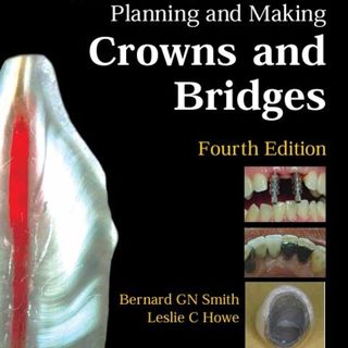 Planning and Making Crowns and Bridges