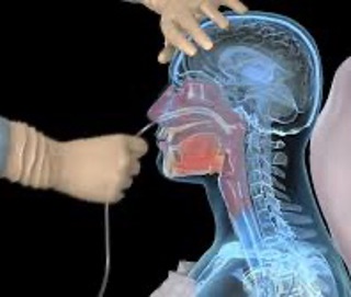 Podcast 542: Nasogastric Tubes