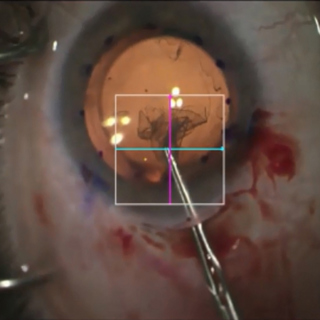 Donor, Recipient, and Operative Factors Associated With Increased Endothelial Cell Loss in the Cornea Preservation Time Study