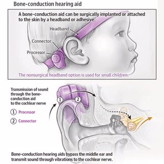 Hearing Loss in Children