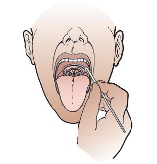 Podcast #208: Vocal Cord Dysfunction