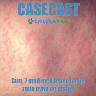 Case - Gutt 7 mnd med feber, hoste, røde øyne og utslett