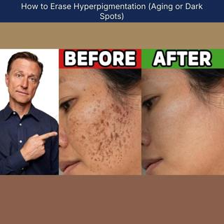How to Erase Hyperpigmentation (Aging or Dark Spots)