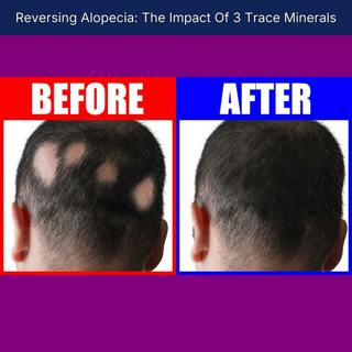 Reversing Alopecia: The Impact Of 3 Trace Minerals