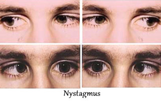 Podcast #318: Nystagmus