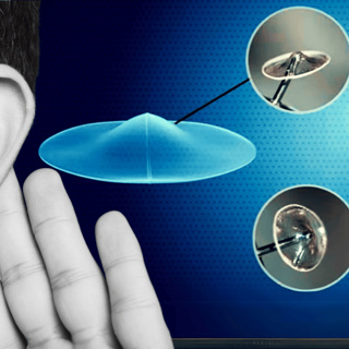 251 - How ClearDrum Could Transform Tympanic Membrane Repair and Recovery