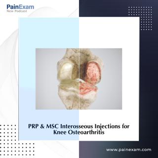 Interosseous PRP for Knee OA